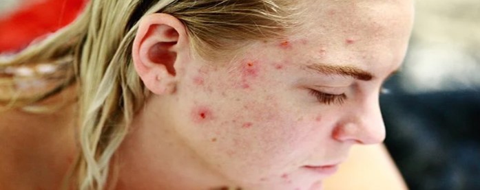 女孩挤痘引发颅内感染，原来直接用脏手挤痘这么危险？